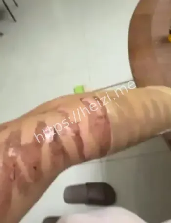 女网红光子嫩肤烧伤事件